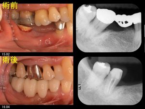 歯周病の症例