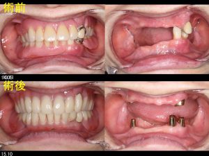 義歯の症例１